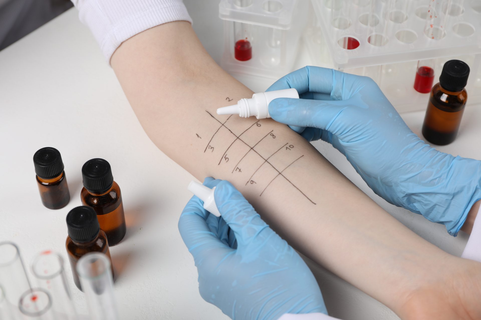 prick test