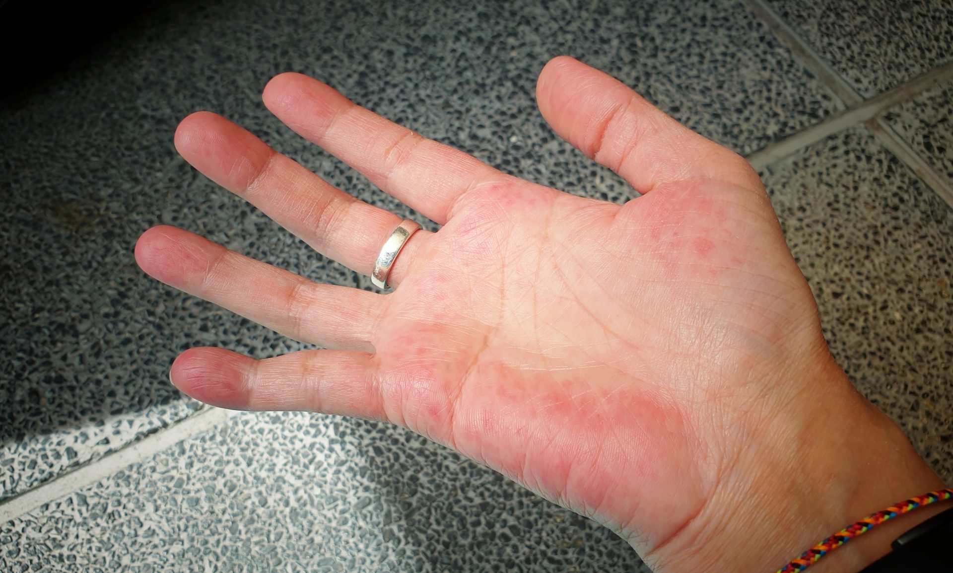 mano di donna arrossata causata dal lupus