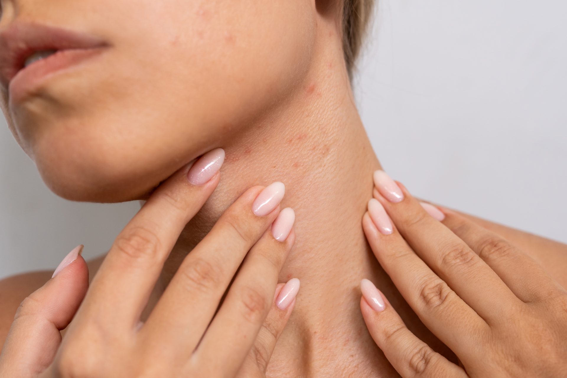 donna con sudamina sul collo