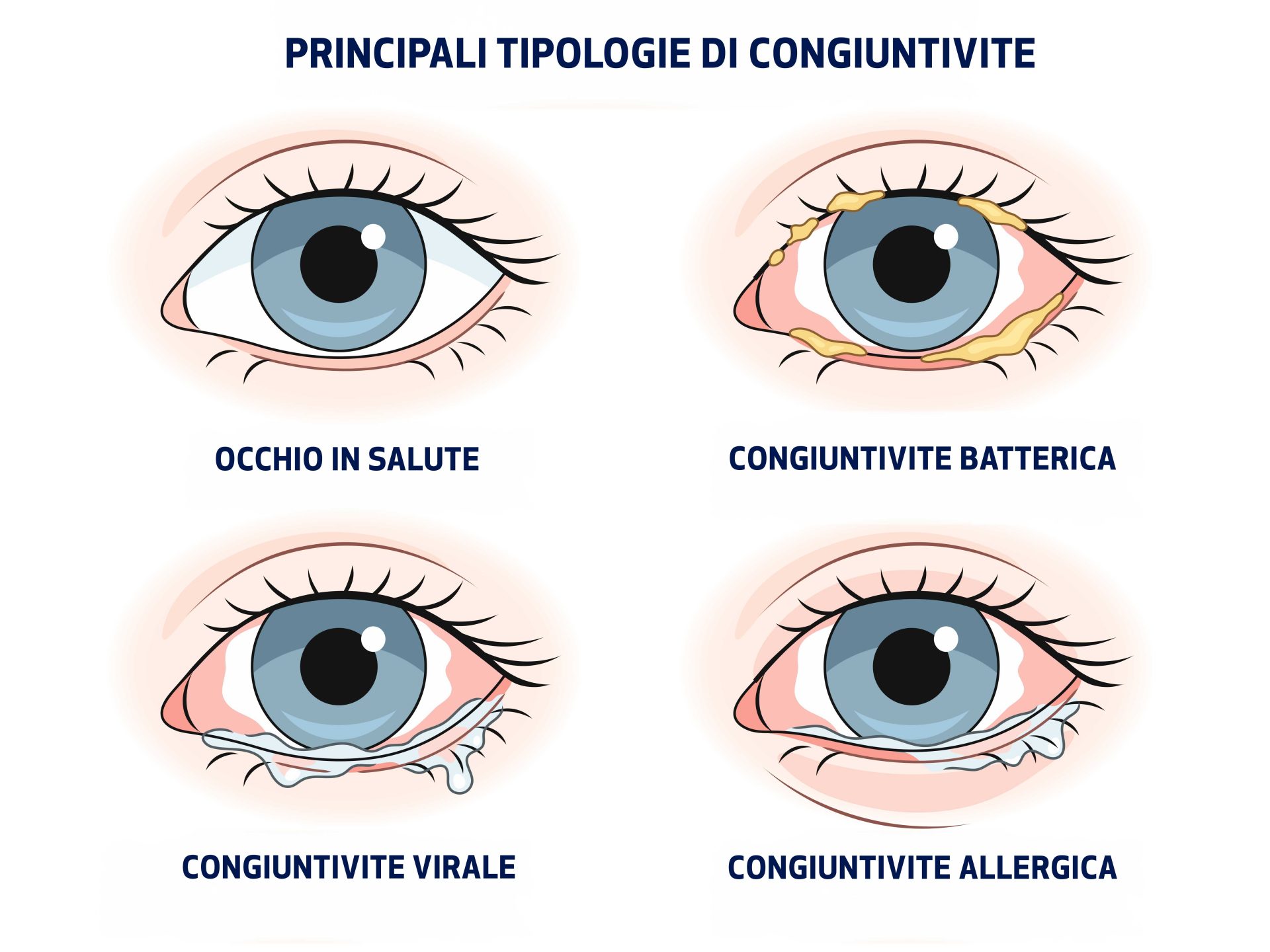 tipi di congiuntivite