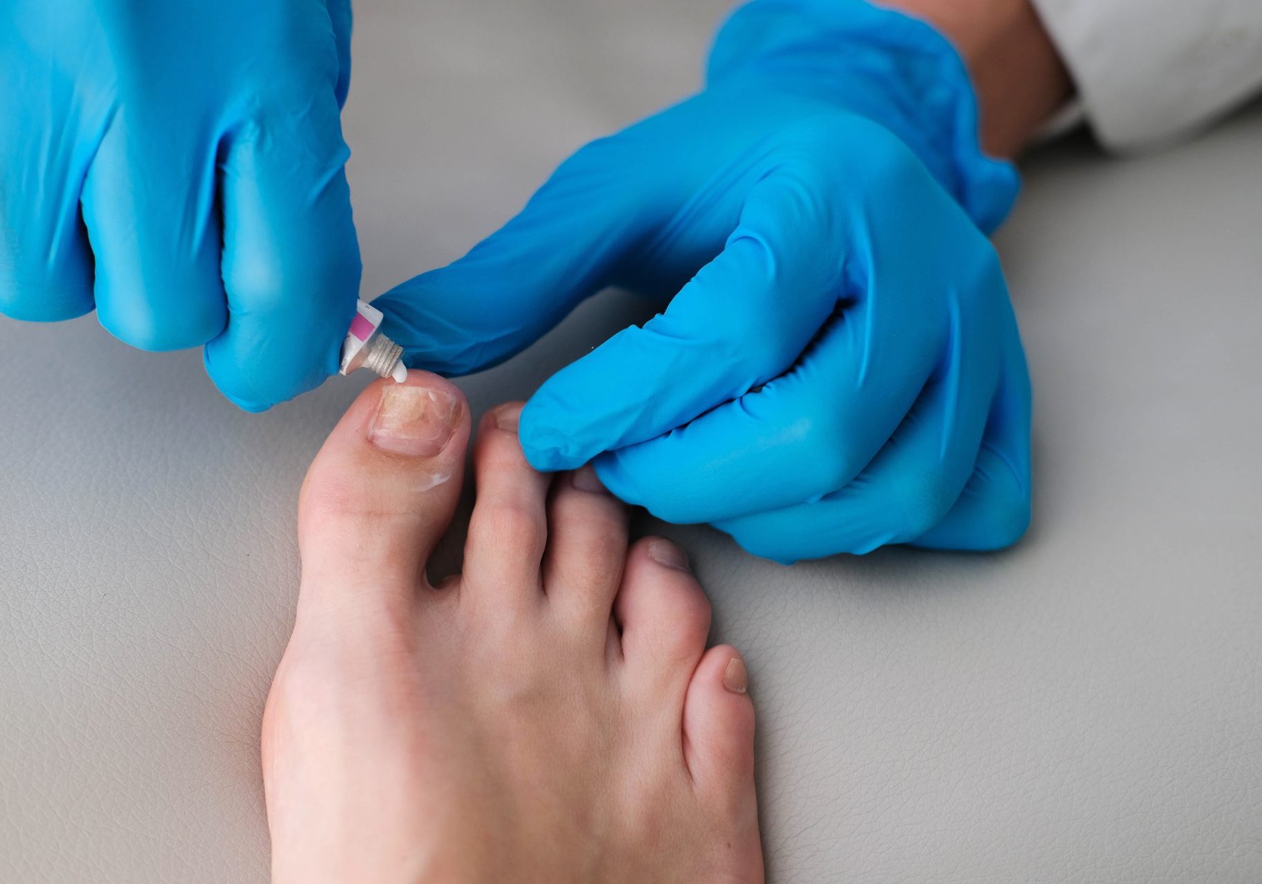 micosi-unghie-piedi_cover medico applica pomata contro una micosi dell'unghia dell'alluce